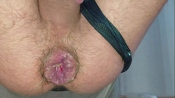 A stretched anus reveals a hemorrhoidal prolapse from riding a giant bottle. Amazing hardcore fisting at home.